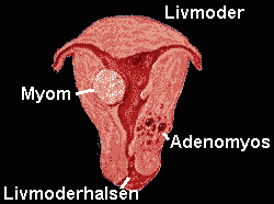 en bild som visar Adenomyosis och myom i livmoderväggen