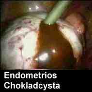 Endometrios chokladcysta