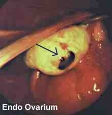 endometrios på äggstock